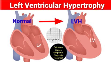 lvh medical abbreviation|lvh prognosis.